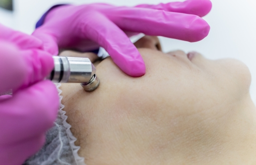 renov-peeling de diamante-13